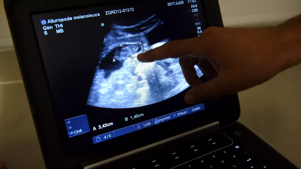 İLERİ YAŞTA BABA OLANLARIN ÇOCUKLARINDA GENETİK HASTALIK RİSKİ