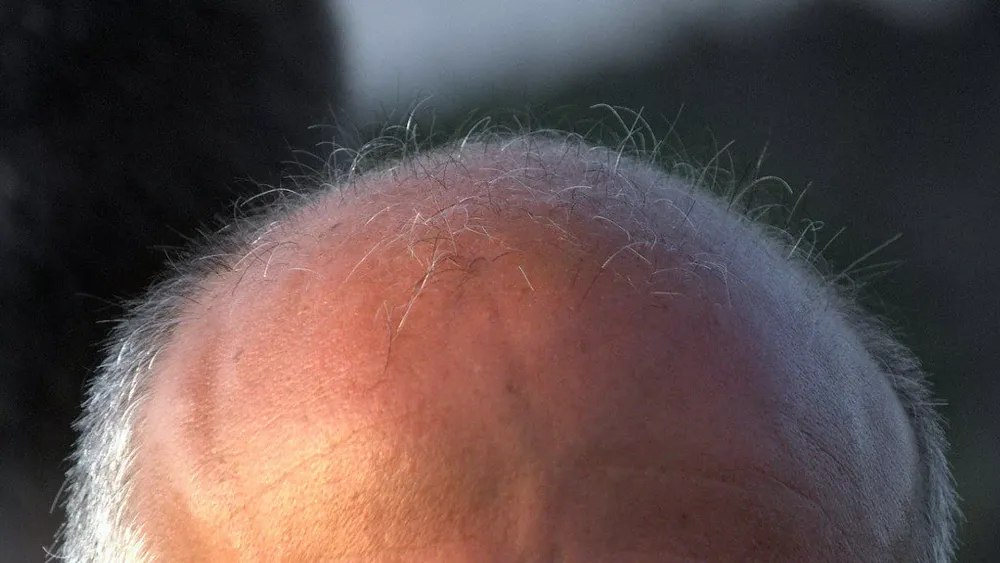 ERKEK TİPİ KELLİK İÇİN İLAÇ BULUNDU